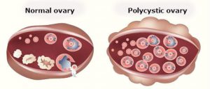 علاج تكيس المبايض