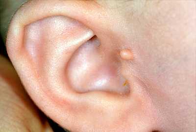 Photo of إلتهاب الأذن- علاج إلتهاب الأذن – أعراض إلتهاب الأذن