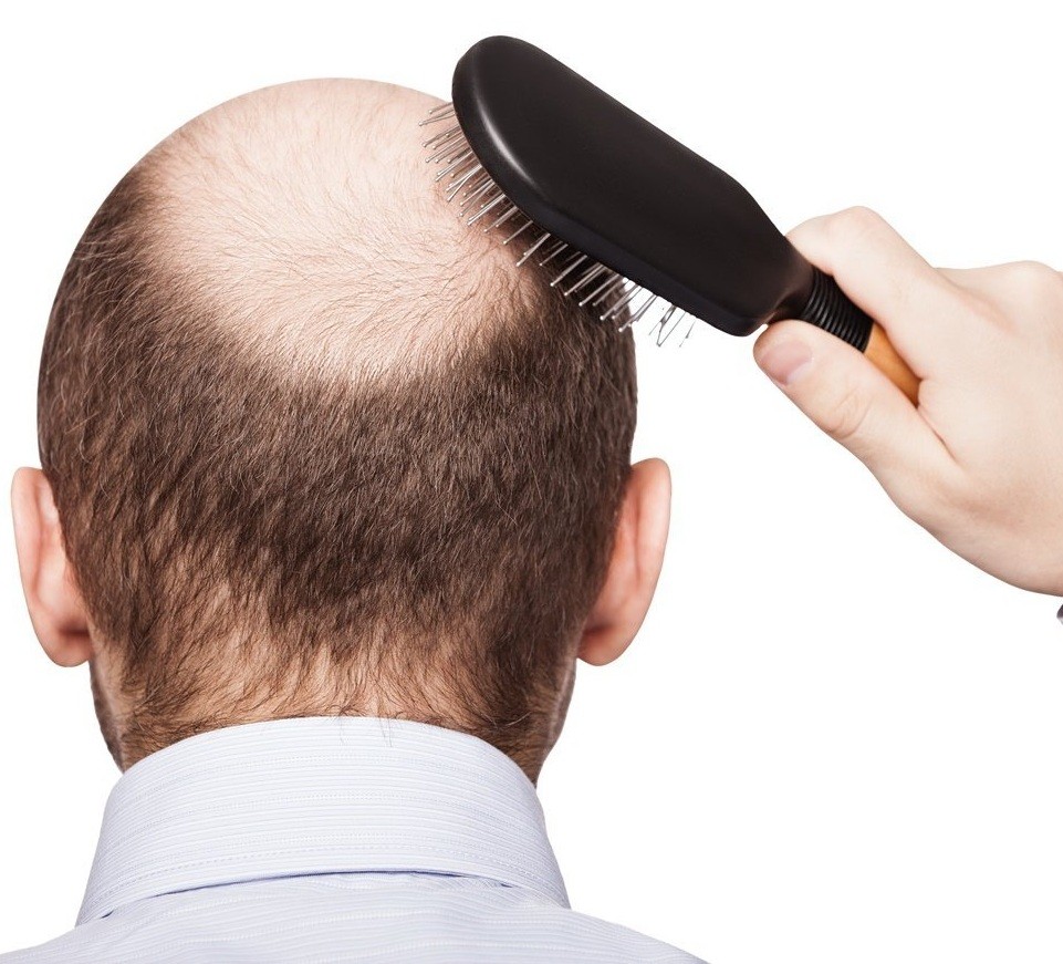 زراعة الشعر