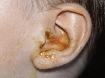 علاج التهاب الأذن الوسطى المزمن