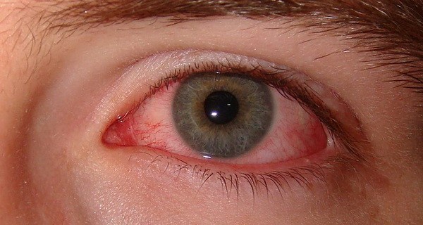 احمرار العين وعلاج التهابات العين