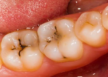 تسوس الاسنان dental caries