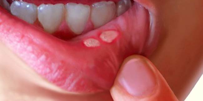 فطريات الفم اسباب وطرق علاج فطريات الفم