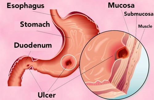 قرحة المعدة