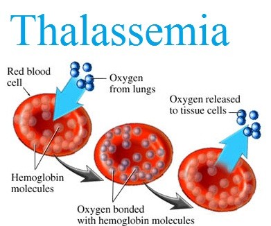 اسباب مرض الثلاسيميا