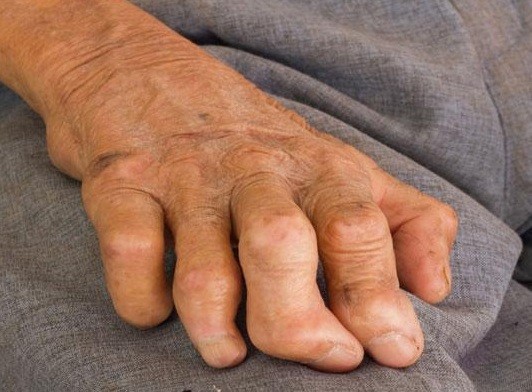 هل الجذام معدي؟