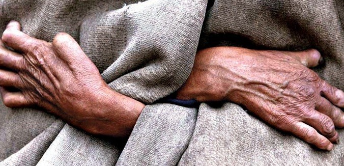 ما هو مرض الجذام؟ أسبابه وأعراضه وطرق علاجه