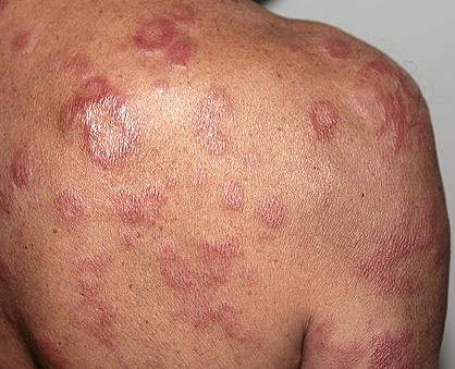ما هو مرض الجذام؟ أسبابه وأعراضه وطرق علاجه