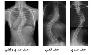 مرض الجنف: أسباب تقوس العمود الفقري وأعراضه وطريقة علاجه