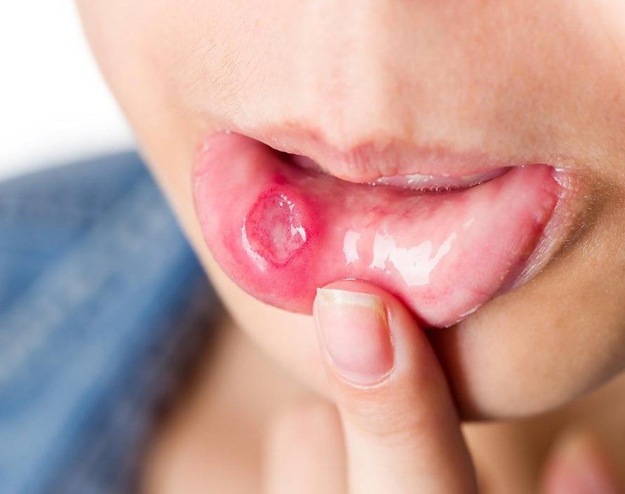 علاج فطريات الفم بالاعشاب والطب الطبيعي