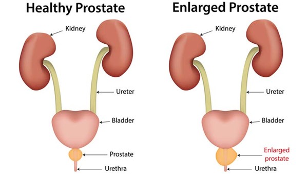اسباب الاصابة بالبروستاتا