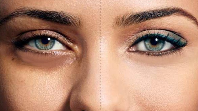 علاج الهالات السوداء حول العين نهائيا