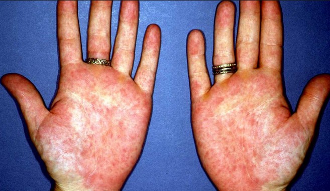 مرض الروماتويد وعلاجه بالأعشاب. موسوعة بيت الطب