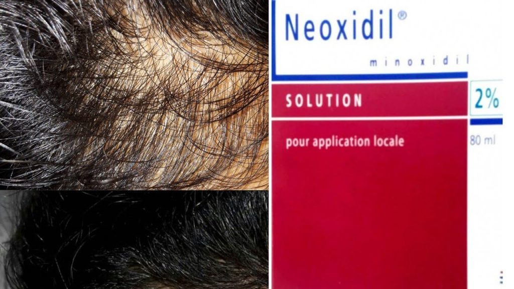 سعر نيوكسيديل بخاخة NEOXIDIL