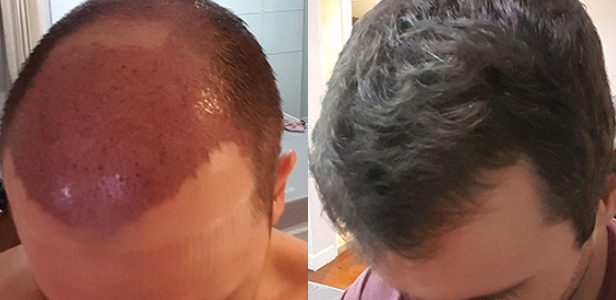 احدث تقنية لزراعة الشعر 2018