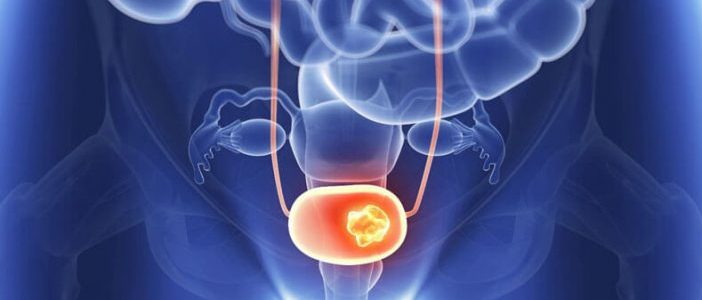 علاج حصوات الحالب بالأعشاب بدون خطورة وبطرق مجربة ومضمونة