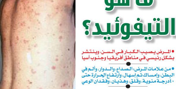 التيفود اعراضه وعلاجه