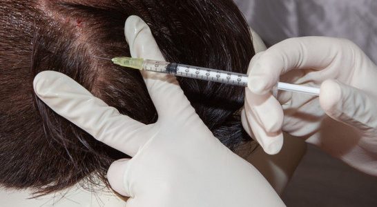 حقن البلازما للشعر