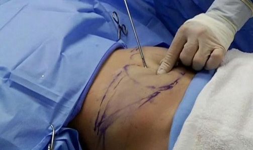 عمليات شفط الدهون