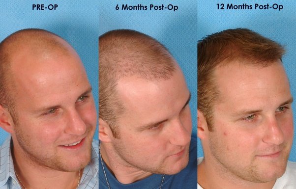 سعر زراعة الشعر بالاقتطاف