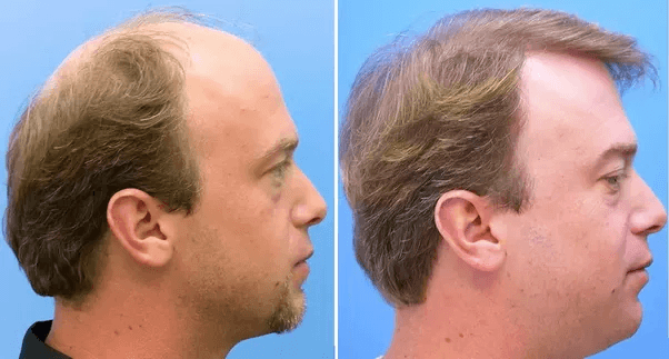 زراعة الشعر بالاقتطاف
