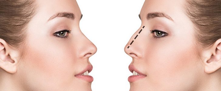 عملية تجميل الانف بدون جراحة