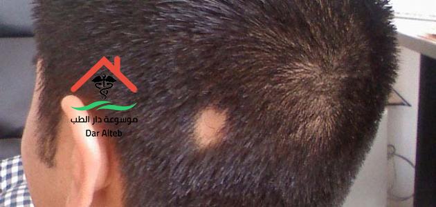 علاج الثعلبة نهائيا موسوعة دار الطب