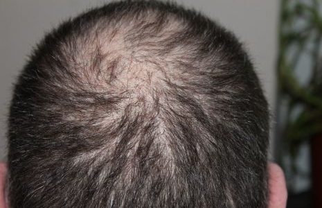 علاج مرض القراع وأعراضه والأسباب التي تؤدي للإصابه به