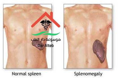 اعراض تضخم الطحال وطرق العلاج
