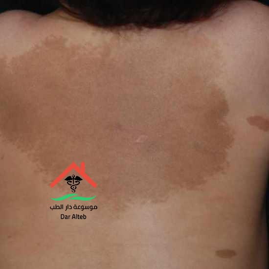 Photo of علاج النخالة البيضاء والأسباب التي تؤدي للإصابه بها