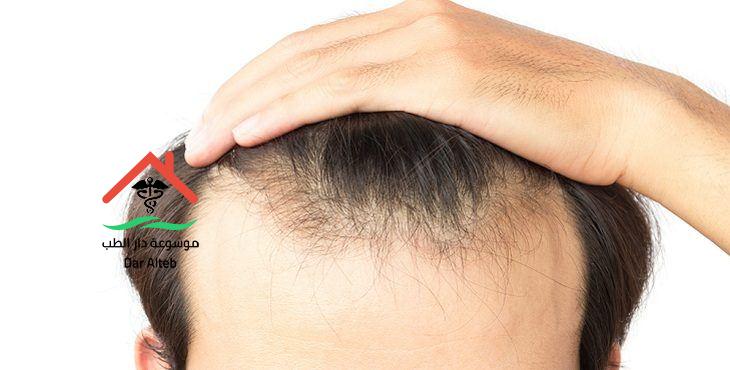 عملية زراعة الشعر وتكلفة زراعة الشعر