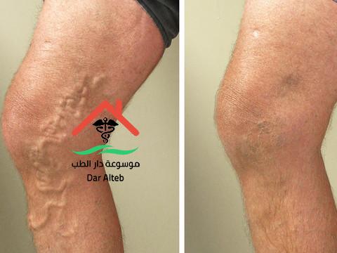 علاج الدوالي