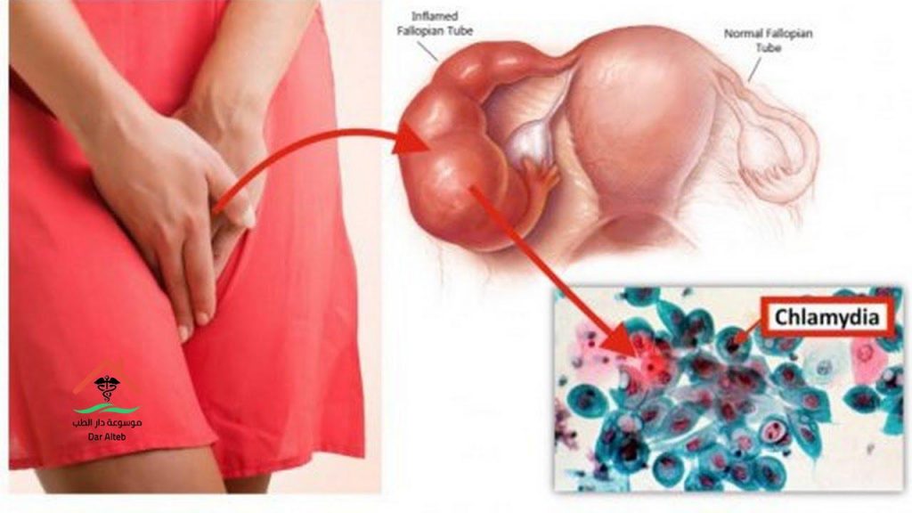 Photo of علاج الكلاميديا – Chlamydia وأعراضها والأسباب التي تسبب الإصابة به