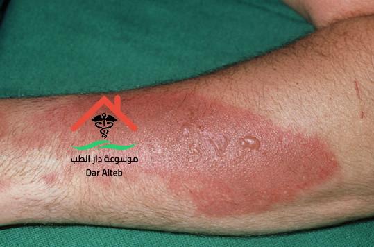 طرق علاج الجروح الملتهبة موسوعة دار الطب