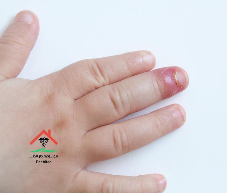 علاج الإصبع المدوحس
