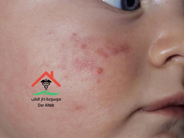 الأمراض الجلدية عند الاطفال بالصور