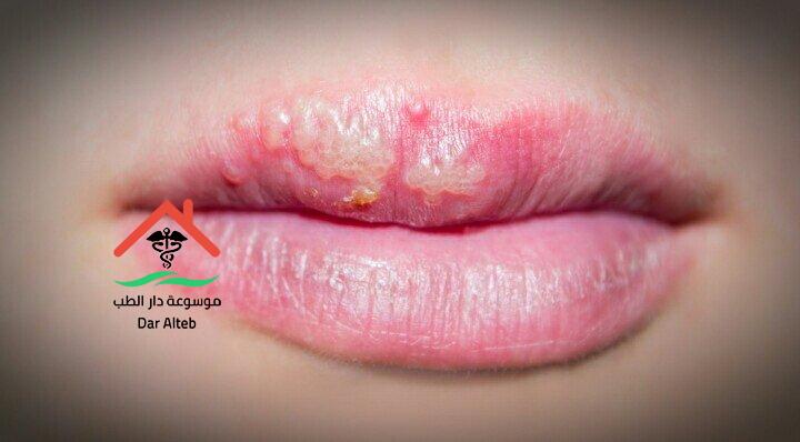 علاج فطريات الشفاه – أفضل 15 علاج لفطريات الشفاه قمرين