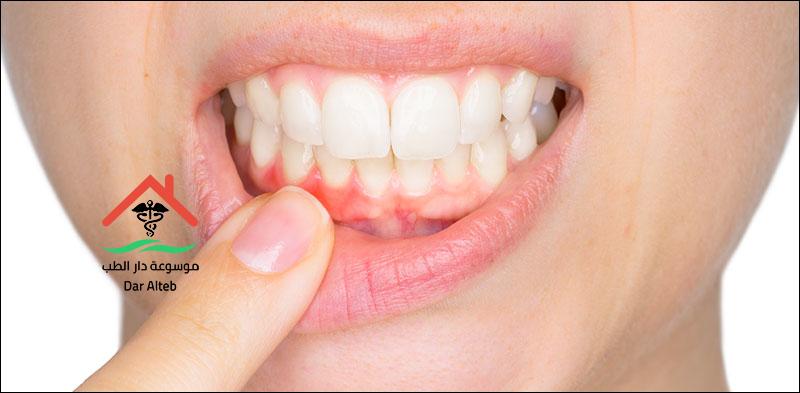 علاج الحمى المالطية بالاعشاب موسوعة دار الطب