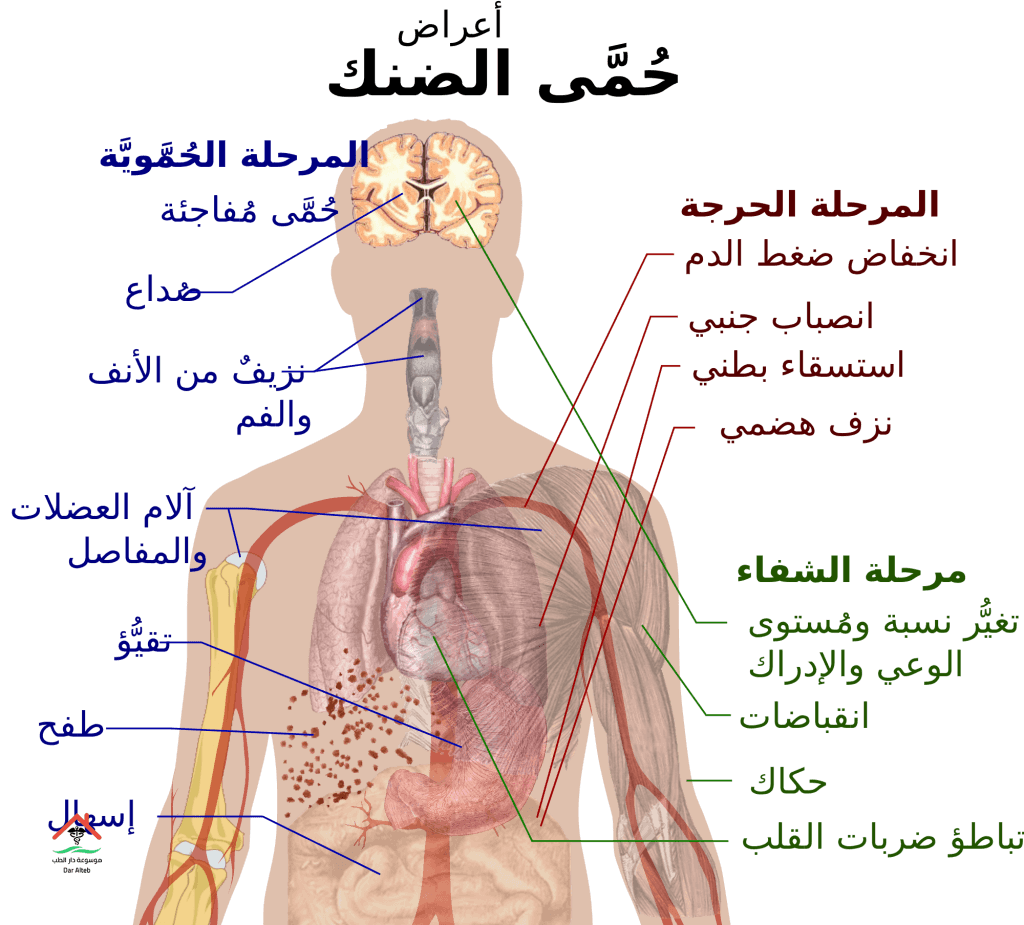 حمى الضنك بالانجليزي