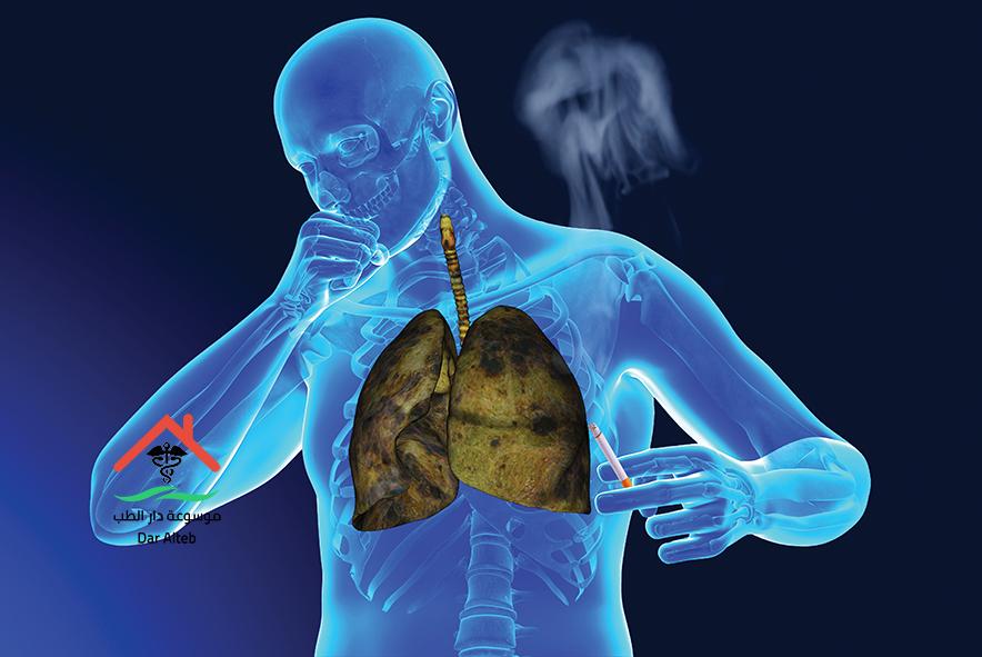 Photo of أعراض سرطان الرئة وما هي أشهر أسباب الإصابة به