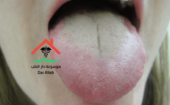 Photo of التهابات اللسان الفطرية اسبابها وطرق العلاج