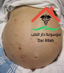 استسقاء البطن