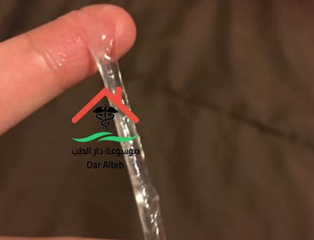 الإفرازات المهبلية، أسبابها، وطرق التخلص منها. موسوعة بيت الطب