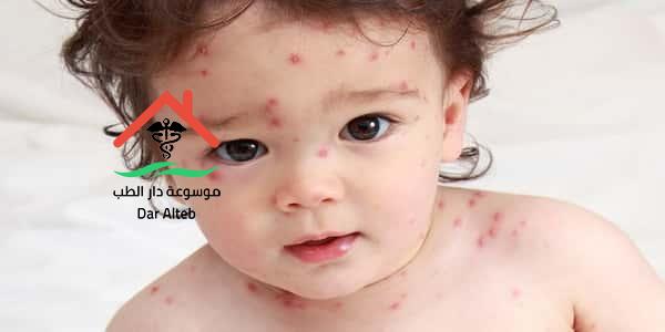 اعراض الجدري وطرق العلاج
